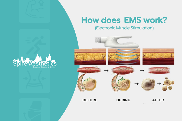 EMS treatment for post pregnancy weight loss treatment Fairfield