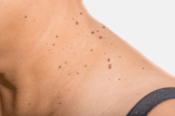 Are you looking for easy skin tag removal Fairfield - then contact Spire today!