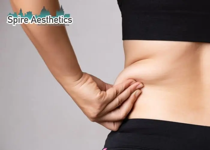 Image of woman pinching fat on their hips Fairfield. Fat Freezing treatment