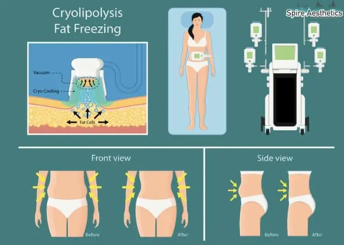Fat freezing treatment Fairfield benefits for competitions to remove stubborn fat deposits.