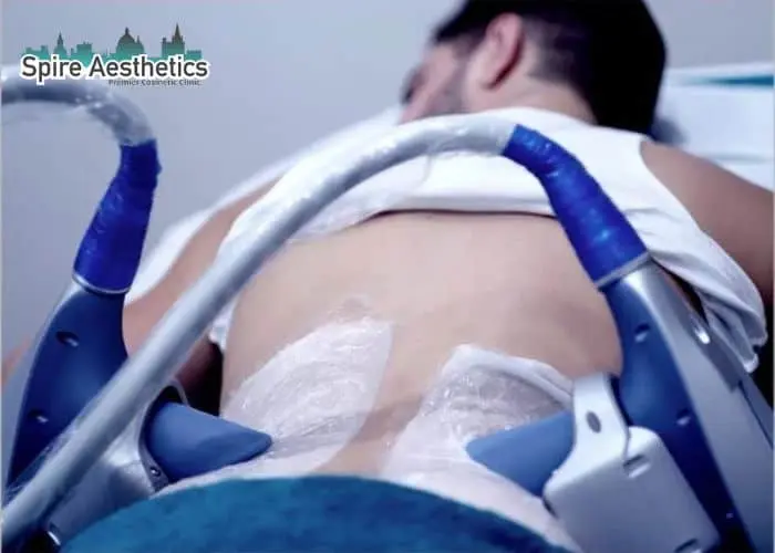 Man having fat freezing treatment done on love handles before a competitions Fairfield to create a sculpted look.